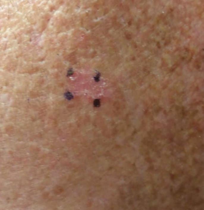 scc skin cancer example