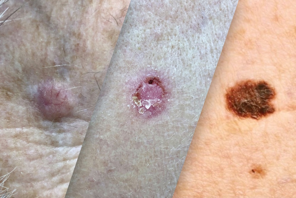 skin cancer types