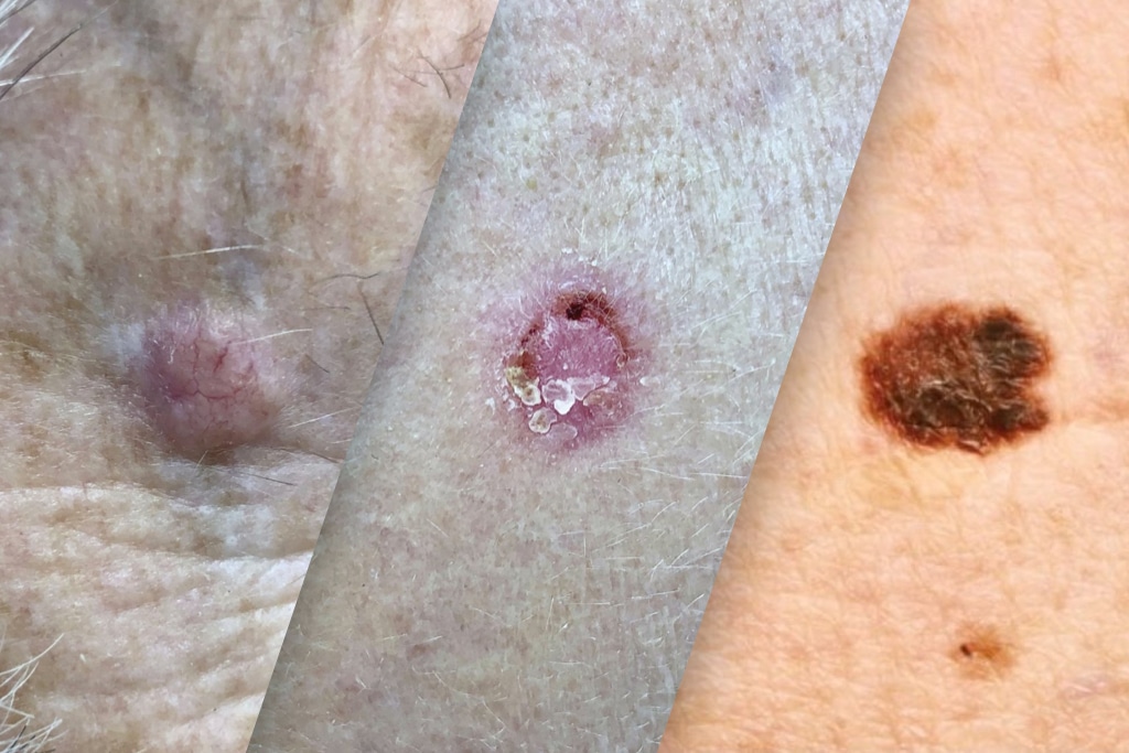 Examples Of Skin Cancer Types