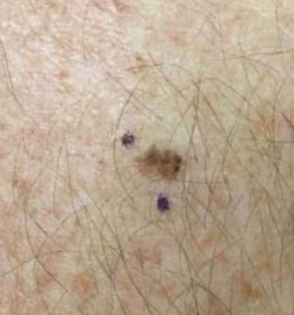 melanoma type of skin cancer