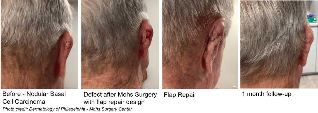 Mohs Surgery best mohs surgeon