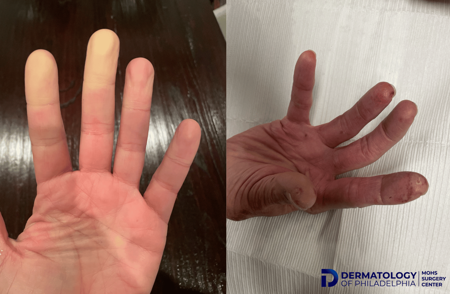 Broken Finger | Symptoms and Treatment | OrthoIndy Blog